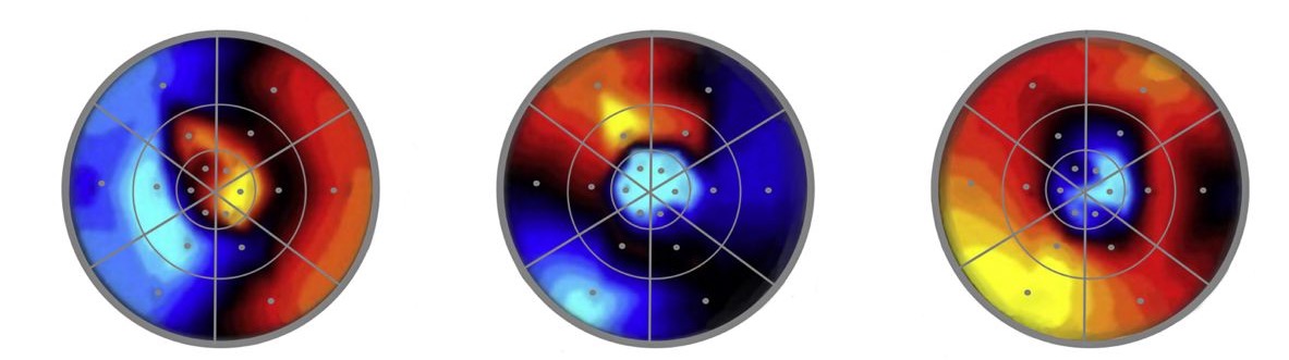 Excerpts from Datta and DeYoe’s “library” of attentional distributions. Attending to one section of the visual field brings about attentional benefits for neighboring and non-neighboring regions. Yellow and red indicate increased neuronal activity in the areas of medial occipital visual cortex encoding each of the eighteen sections in Datta and DeYoe’s stimulus grid, when participants were directing their attention to sections 6, 9 and 17, respectively. Yellow indicates greater benefits. Adapted from Vision Research, May 49 (10), Datta, R. and E. A. DeYoe, “I know where you are secretly attending! The topography of human visual attention revealed with fMRI.” 1037-1044, Copyright (2009), with permission from Elsevier. Many thanks to Zara Morgue for creating this figure.